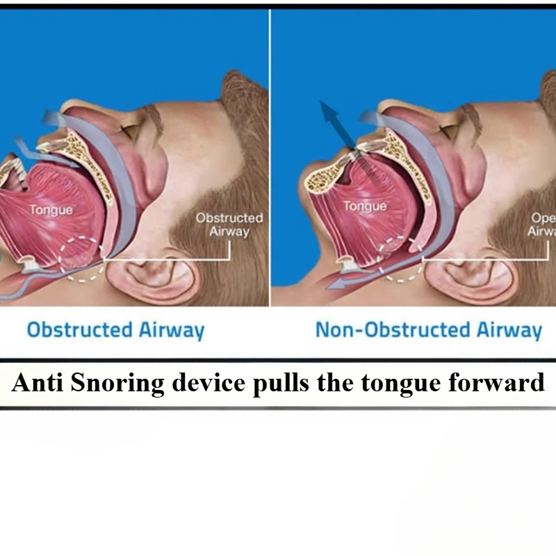 Anti Snoring Mouthpiece Tongue Retainer Helps to Eliminate Snoring Anti Snore Device Silicone Snore Sleep Apnea Anti Ronflement