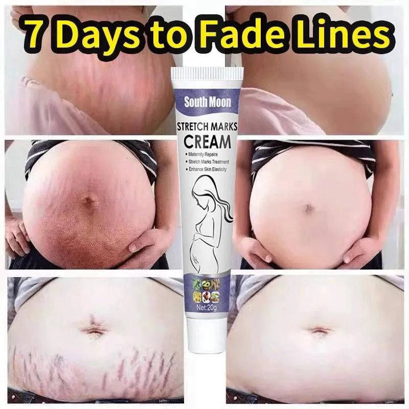 Creme de Remoção Permanente de Estrias, Eliminar Barriga Corporal, Túneis, Anti-Winkle Refirmante, Cuidados com a Pele, 7 Dias