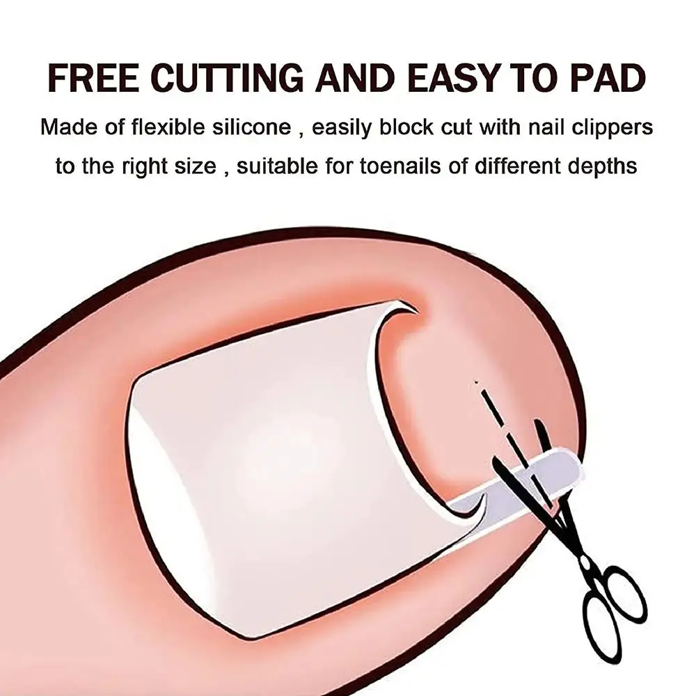 แผ่นแก้ไขเล็บขบ ยาแก้เล็บขบ แผ่นยืดเล็บเท้า บรรเทาอาการปวด อุปกรณ์แก้ไขเล็บ แท่งแก้ไขเล็บ