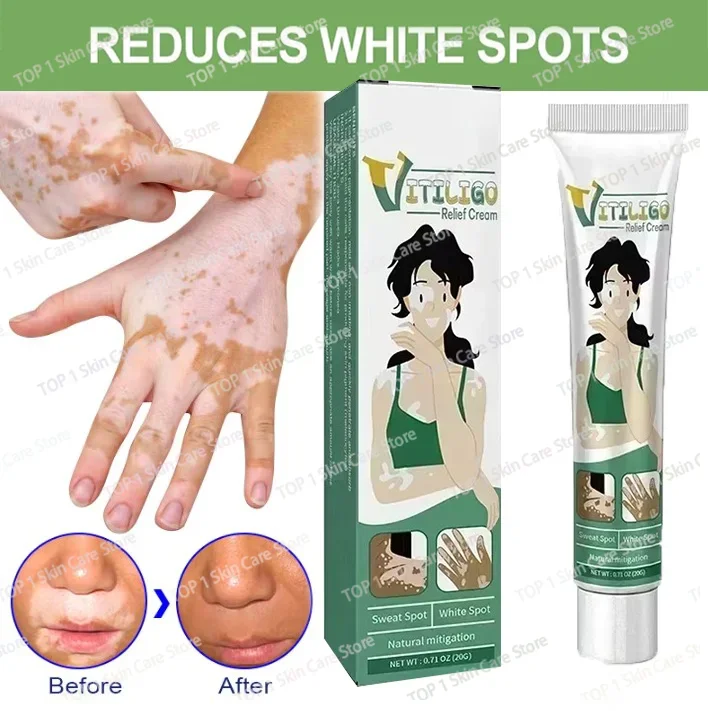 สารสกัดจากสมุนไพร Vitiligo Ointment ลบกลากสีขาว Spot Removal ผิว Vitiligo กําจัด Vitiligo Treatment 0903