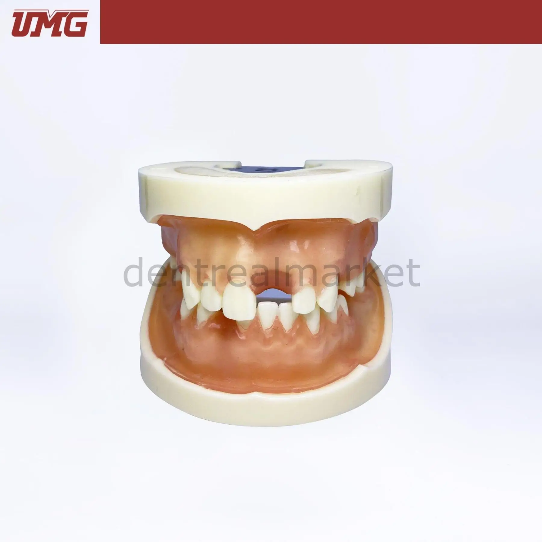 UMG Dental - Umg Model Implant Training Model Upper-Lower Jaw - UM-2002