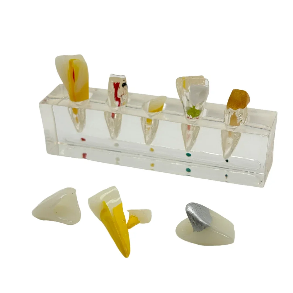 

Dental Endodontic Pathological Anterior Teaching Tooth Model for Labial Use Dentist Training Material