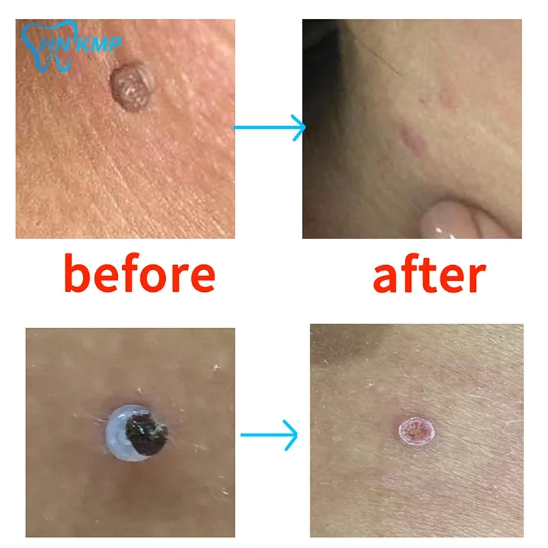 2mm-4mm Remove Skin Tag Shrink Rubber Ring 20pcs/box Non Toxic Health Beauty Skin Care Tools Tag Removal Mole Wart Removal 6