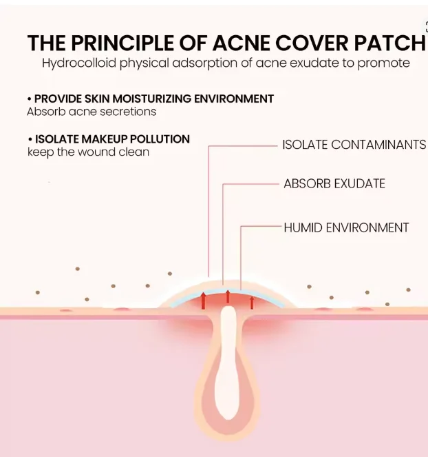 40 Uds. Parches para espinillas de estrellas para hidrocoloides faciales, cubierta absorbente, árbol de té, parche hidrocoloide para acné, lindo parche para espinillas de estrellas.