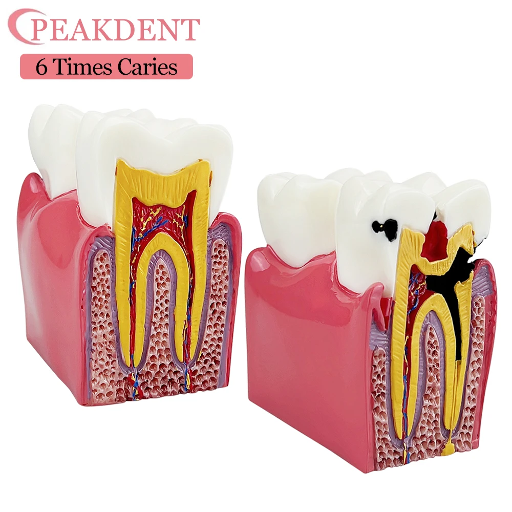 

1PCS Dental Materials Lab Teeth Model 6 Times Caries Comparation Study Models For Dentist Studying and Researching Dental Model