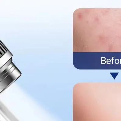 Electric Blackhead Remover Pimple Extractor Kit - Acne & Pore Cleaner Deep Cleaning Tool Set for Facial Skin Care Visualization