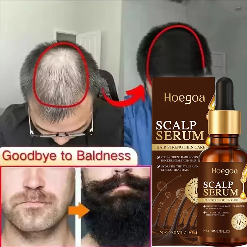 

Касторовое масло, эссенция для быстрого роста волос, предотвращение алопеции, облысение, лечение кожи головы, восстановление корней, увлажнение, уход за волосами для мужчин и женщин