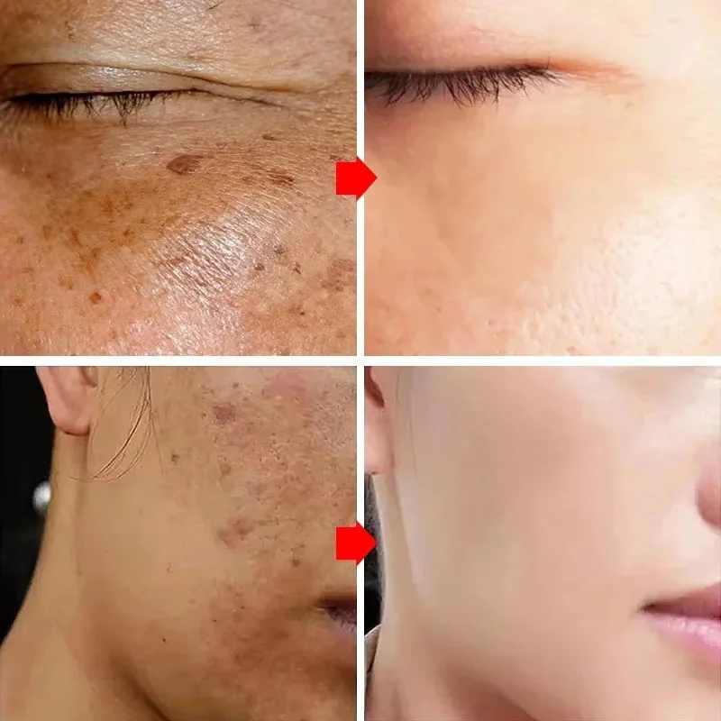 Whitening Freckle Face Cream Remove Melasma Dark Spot Lightening Melanin Brightening Melasma Anti-Aging Skin Care Beauty Product