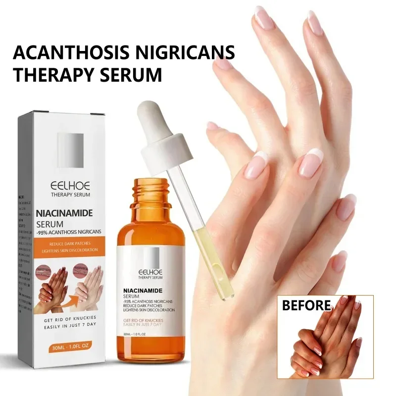 

Sdottor New Acanthosis Nigricans Therapy Oil Dark Spots Underarm elbow joint repair Skin Essence Armpit Knee Thigh Inner remove