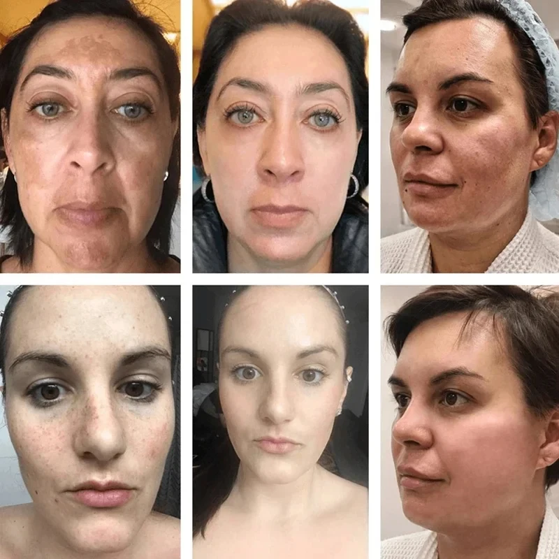 Crema aclaradora facial de niacinamida, suero para el cuidado de la piel oscura, aclara las líneas finas, el brillo, el Chloasma Melasma y la melanina