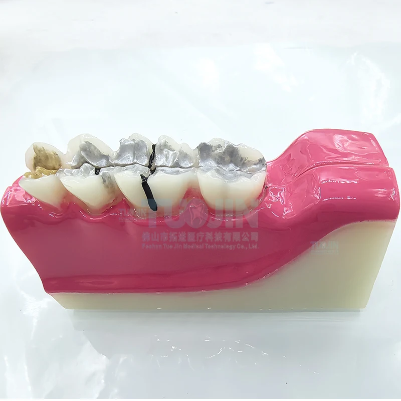 Dental Teaching Model Repair Pathological Impacted Tooth Model Pulp for Dentist Teaching and Training Dental Magnet Dentistry