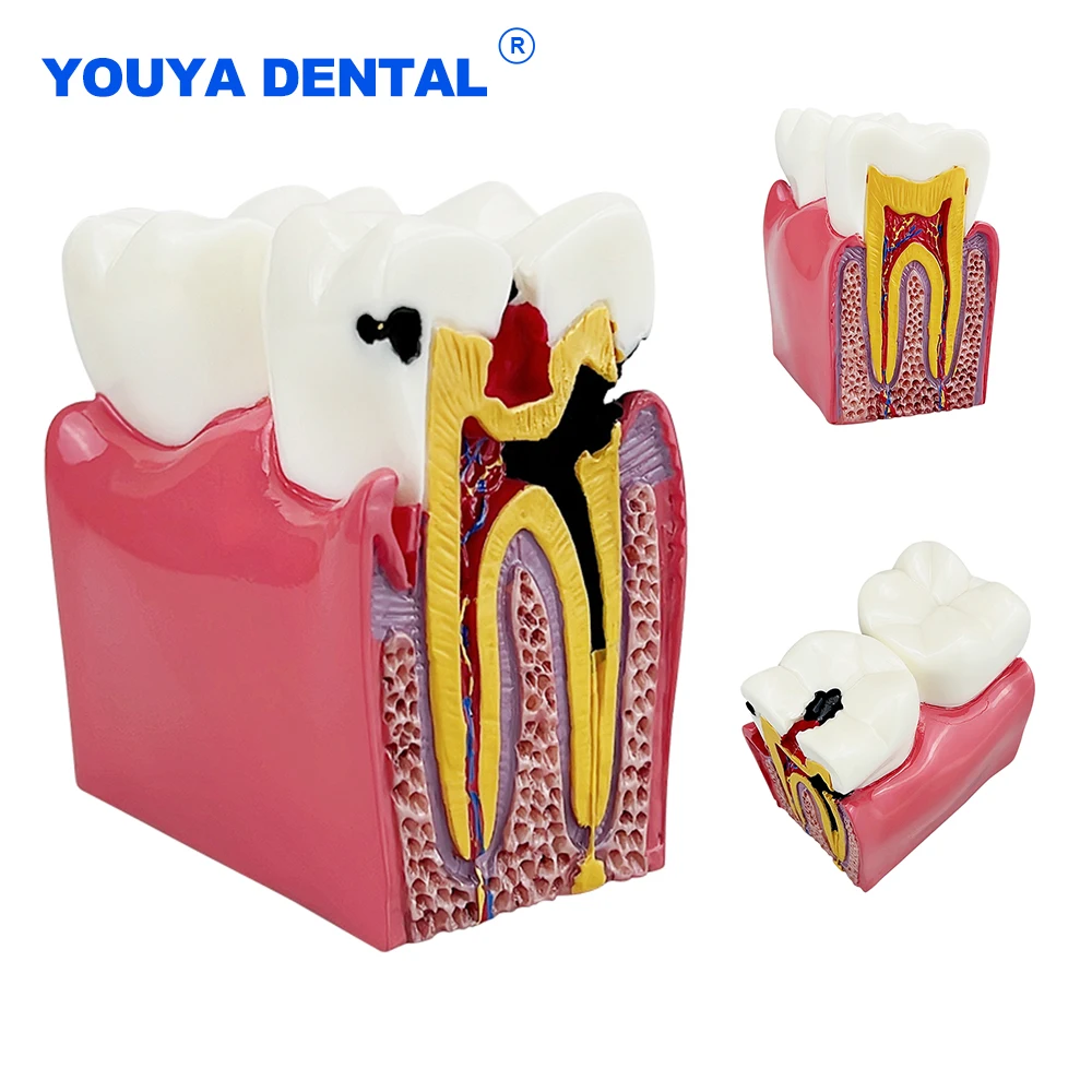 Dental 6 Times Teeth Model Caries Comparsion Models Study Denture Teaching Anatomy Education Teeth Model For Dental Study