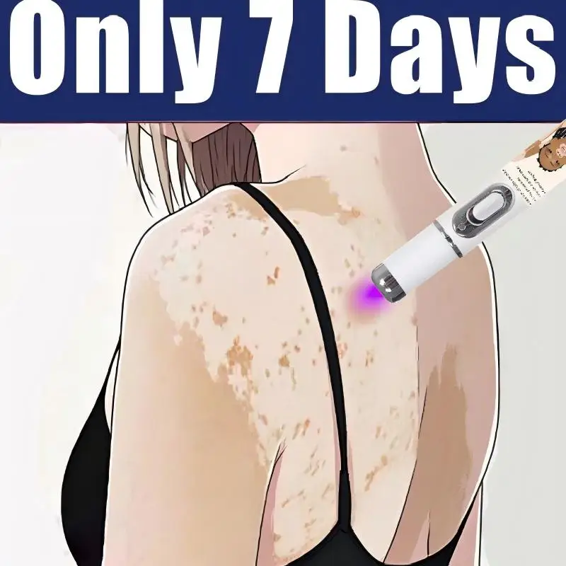 Generatie-2 Laser zegt vaarwel tegen vitiligo in 7 dagen