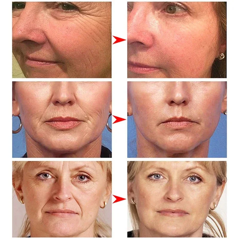 Removedor instantâneo de rugas Creme Facial, Anti Envelhecimento, Refirmante, Levantamento, Fade Linhas Finas, Clareamento, Hidratante, Iluminar,