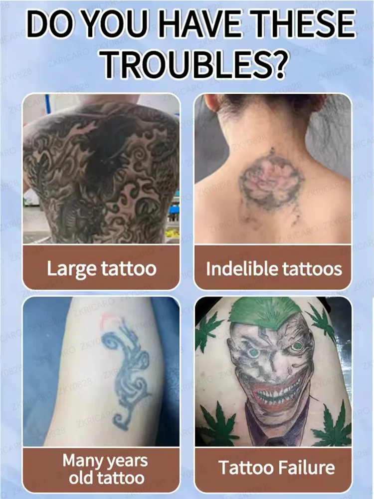 كريم إزالة الوشم السريع يخفف إزالة الوشم بشكل دائم