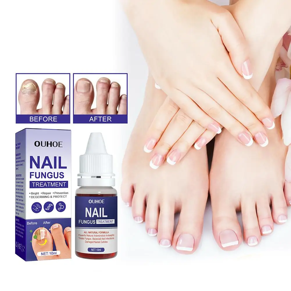 Tratamiento de hongos para las uñas de los pies, reparación de onicomicosis, paroniquia, antiinfección, eliminación de hongos