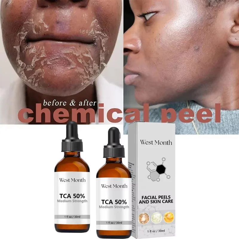 Acid Peeling Serum Chemical Exfoliant Peel For Remove Face Dark Skin Spots Whiten Lighten Melanin Peeling Solution Skin Peel