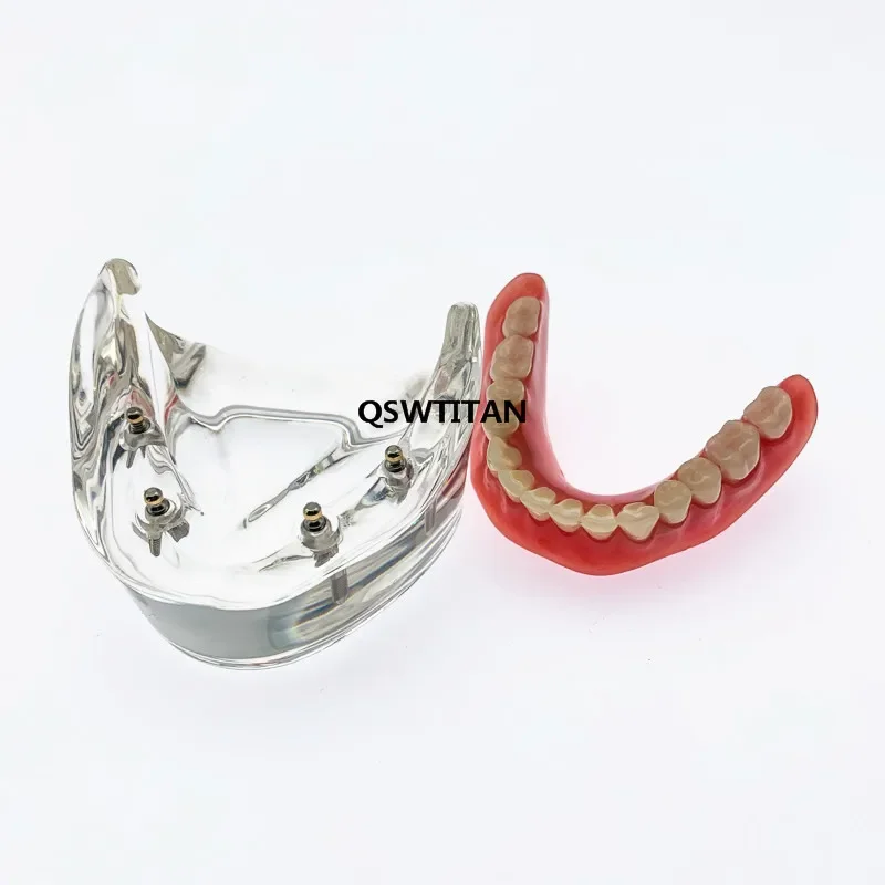 Lower jaw Dental Implant Teeth Model Removable Interior Mandibular Demo Overdenture With Implants for Tooth Teaching Study