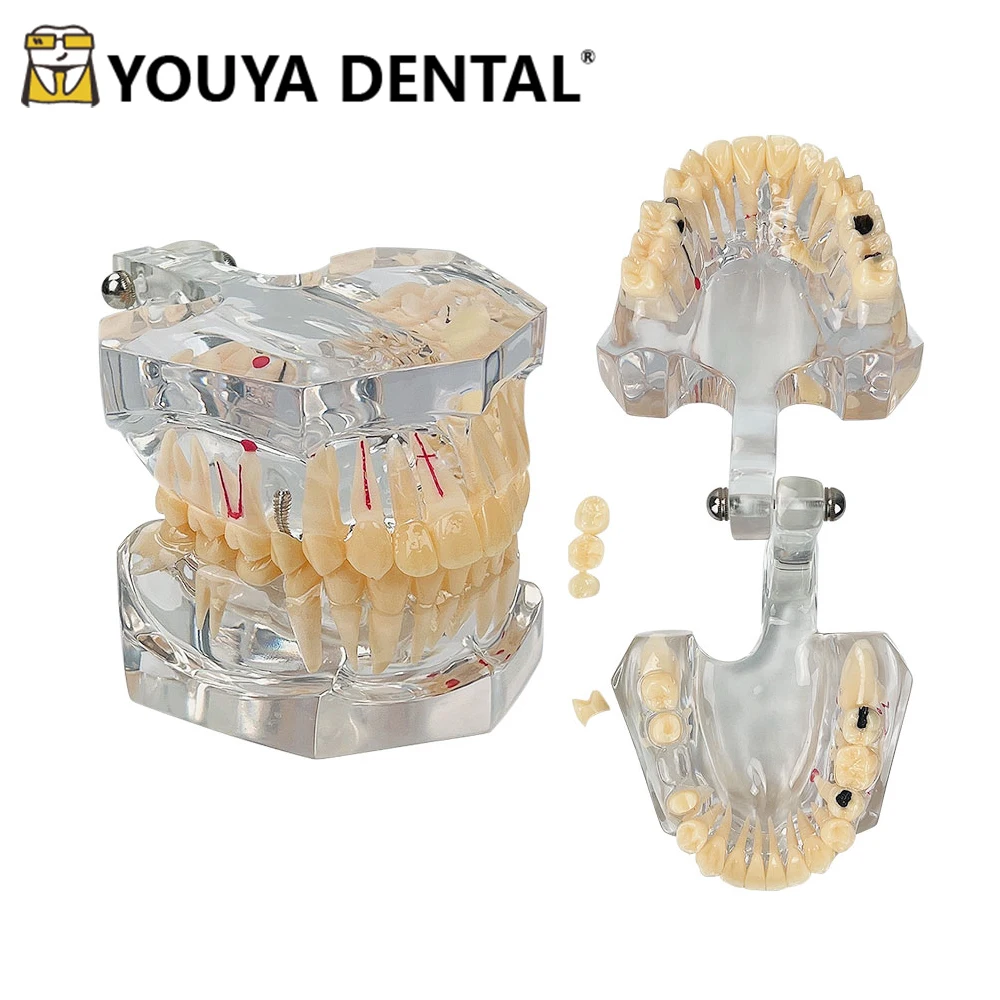 

2.5 Times Pathological Model with Dental Caries for Dentist Student Practice Training Studying Oral Medical Teaching Model