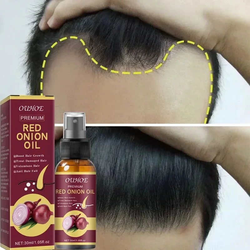 

Onio Fast Hair Growth Serum Anti Hairs Loss Spray Scalp Treatment Products Repair Damaged Frizzy Hair Care Oil For Men Women