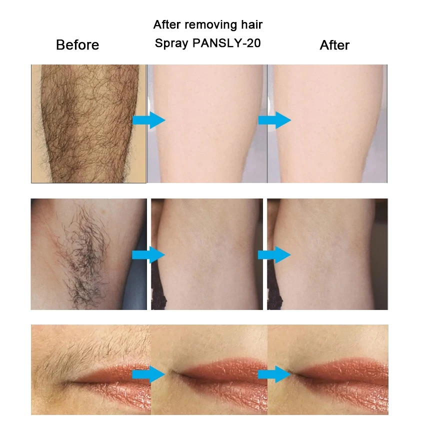 مثبط إزالة الشعر كريم بخاخ ، اللحية ، البيكيني ، الحميمة ، الوجه ، الساقين ، الجسم ، الإبط ، بدون ألم ، 50 *