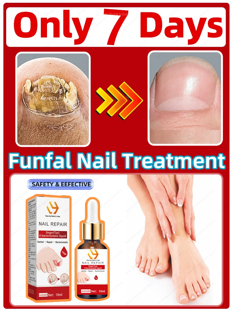 

Fungal Nail Repair Fast Onychomycosis Fungus Nails