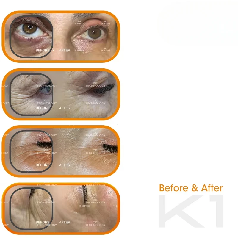 RF Eye Wrinkle Lift Machine Monopolar Rf Machine Eye Care Radio Frequency For Eyes