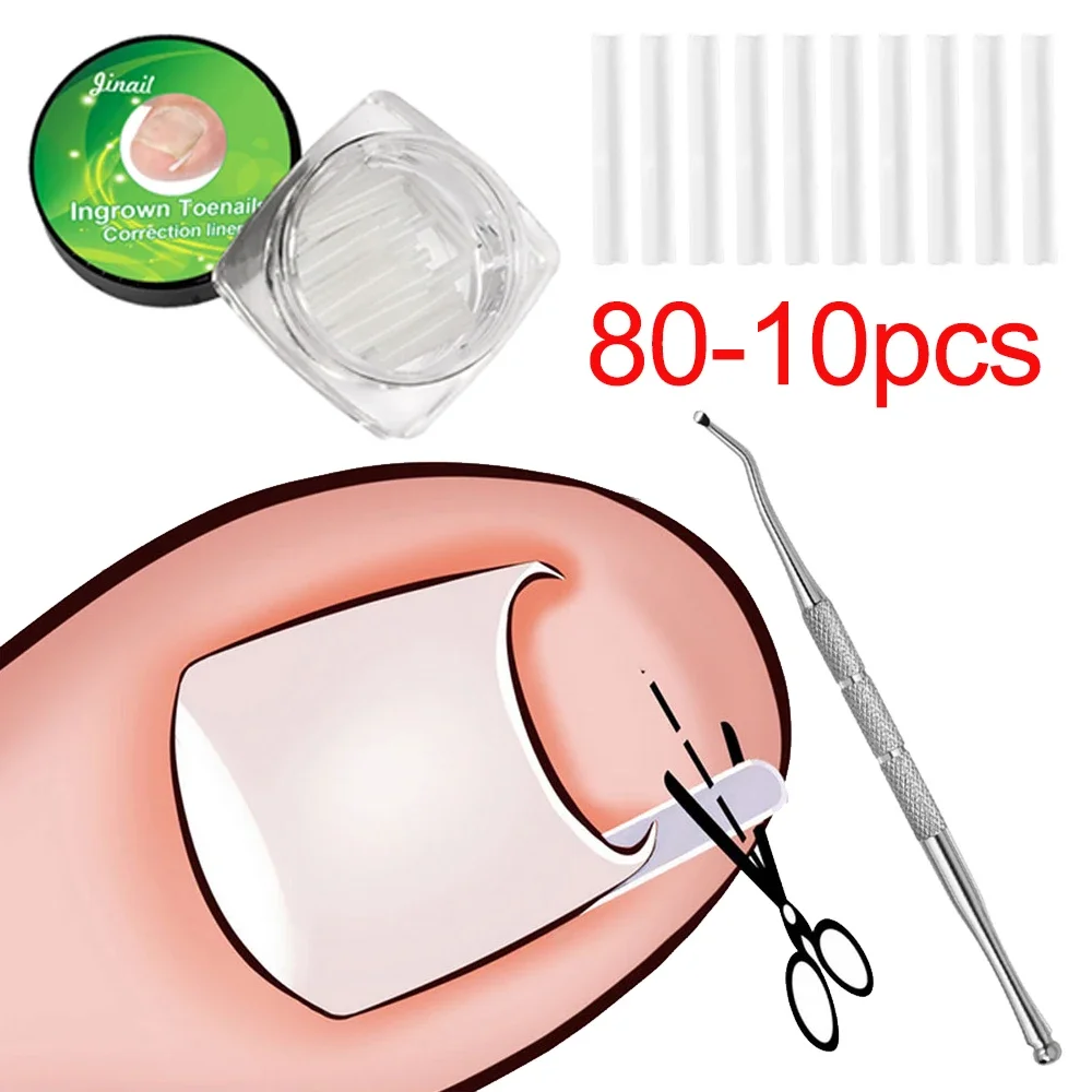 80-10 個陥入爪矯正ツール陥入爪治療弾性パッチステッカー矯正クリップブレースペディキュアツール
