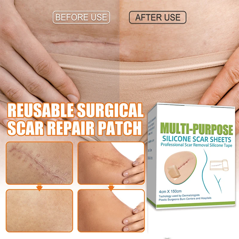 실리콘 흉터 패치 4cmx1.5M 피부 재생 시트 제거 자가 접착 스트레치 마크 테이프 치료 패치 화상 여드름 흉터 피부 관리 ﻿