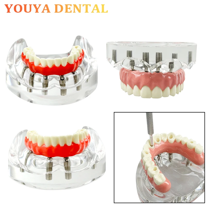 

Dental 4/6 hole Removable Screw Upper/Lower Teeth Transparent Implant Covered Denture Model Dentistry Research Teaching Model