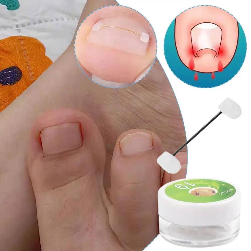 

Ingrown Toenail Corrector Kit Titanium Alloy Memory Steel Wire Clip For Nail Pain Relief Home Care Non Surgical Treatment