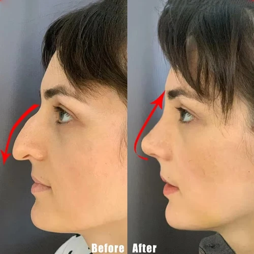 Imagen 2 del producto Aceite esencial para levantamiento de nariz, esencia de masaje para remodelación de huesos nasales, belleza para el cuidado de la rinoplastia