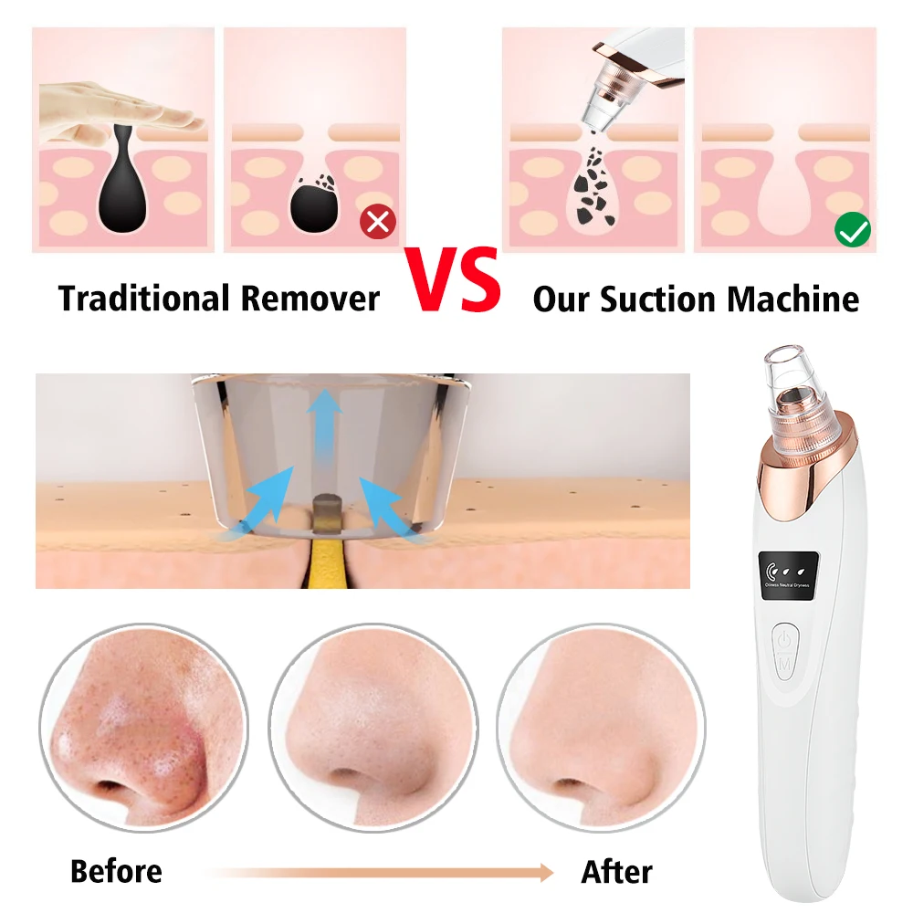 Blackhead Remover สูญญากาศเครื่องดูดสิวทำความสะอาดใบหน้าและ Exfoliating สีดำจุดสิวสิวเสี้ยนกำจัดเครื่องความงาม Skin Care เครื่องมือ