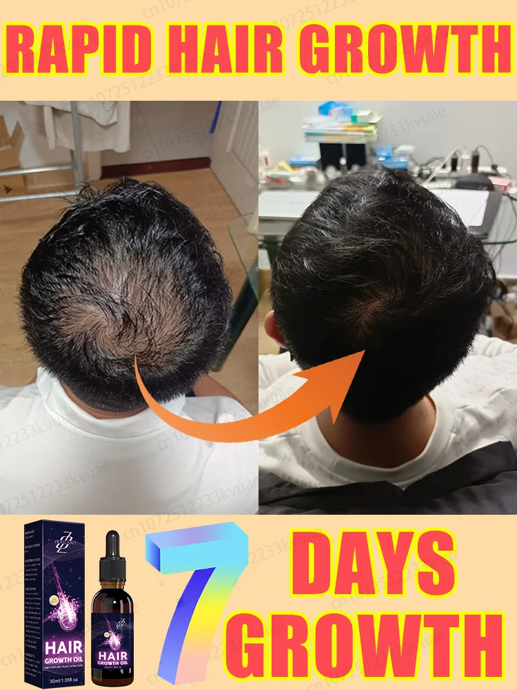 

ᔆᵗⁱᵐᵘˡᵃᵗᵉ ʰᵃⁱʳ ᶠᵒˡˡⁱᶜˡᵉˢ⸴nourish the scalp, and quickly regenerate hair in seven days