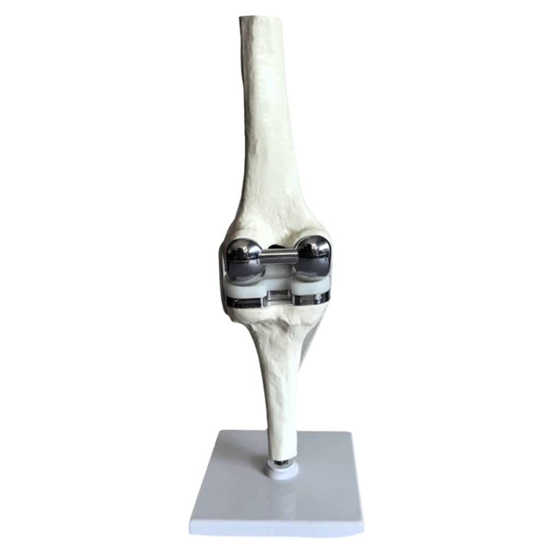 ABEZ Knee Joint Model Simulation Replacement Surgery Meniscus Ligament Cartilages Surgery Model,Artificial Knee Joint