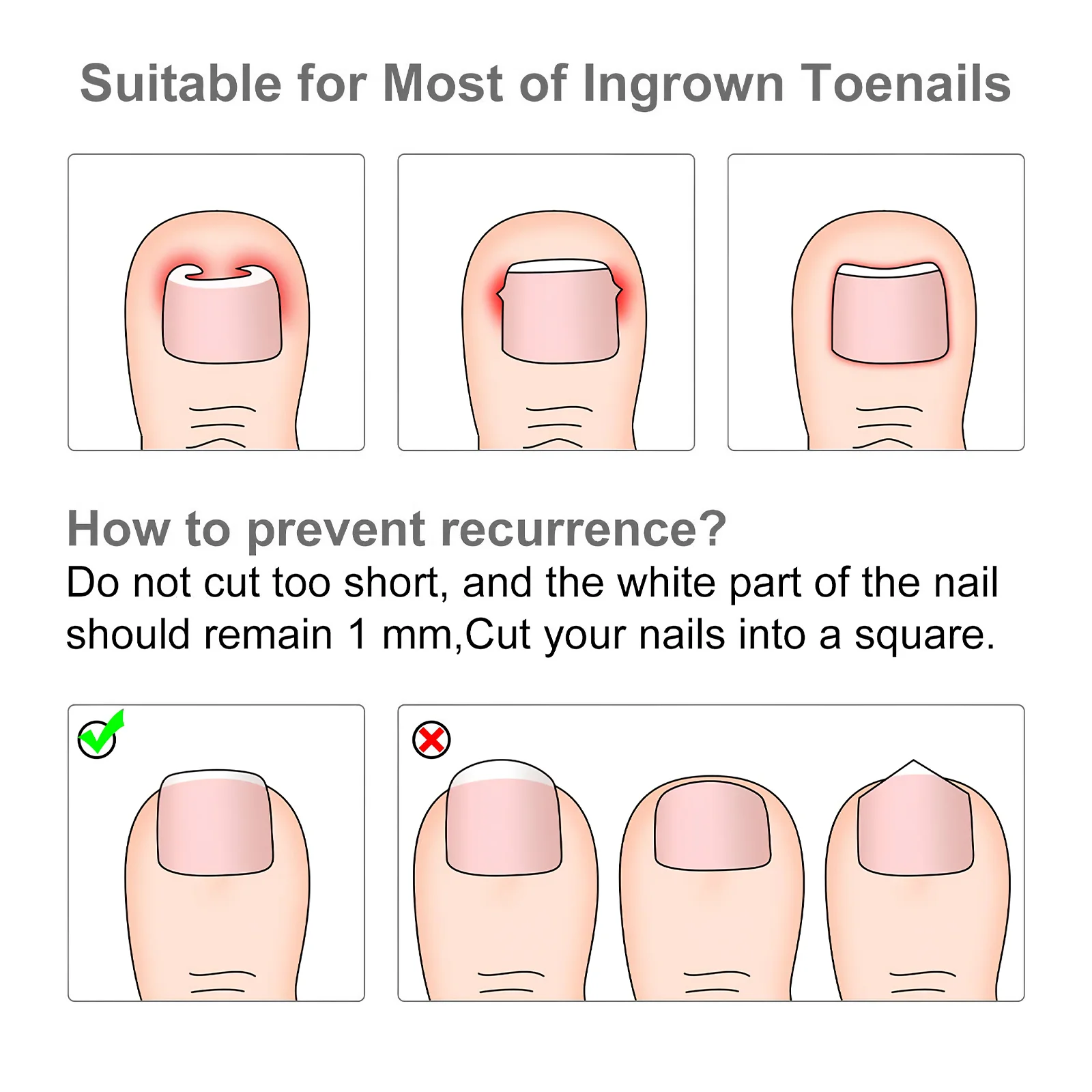 120 pièces orteil Correction des ongles autocollant Patch Paronychia correcteur fichier élastique Patch correcteur ongles Correction Patch