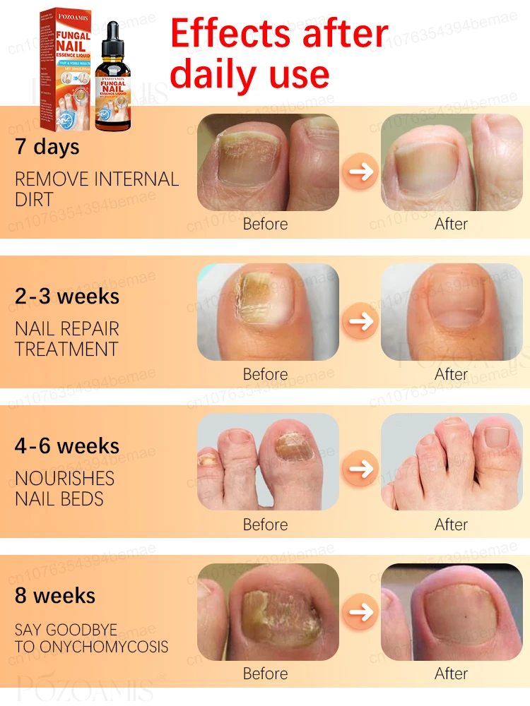 Dì addio ai problemi di chiodi spessi, gialli e fragili