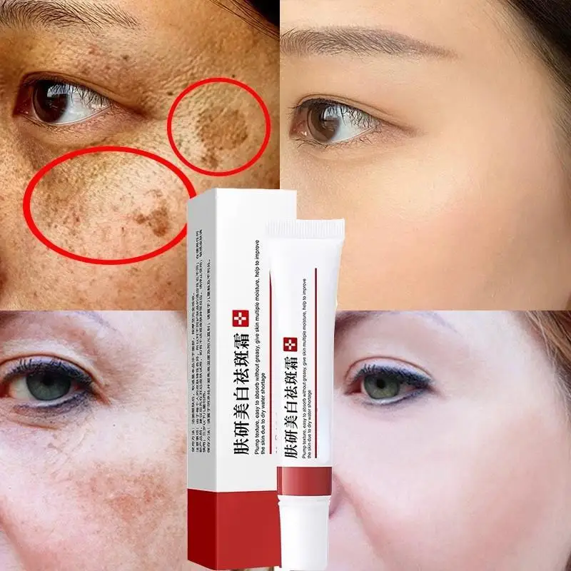 

Whitening Freckle Cream Effective Remove Dark Spots Anti Freckle Cream Fade Pigmentation Melasma Brighten Cream