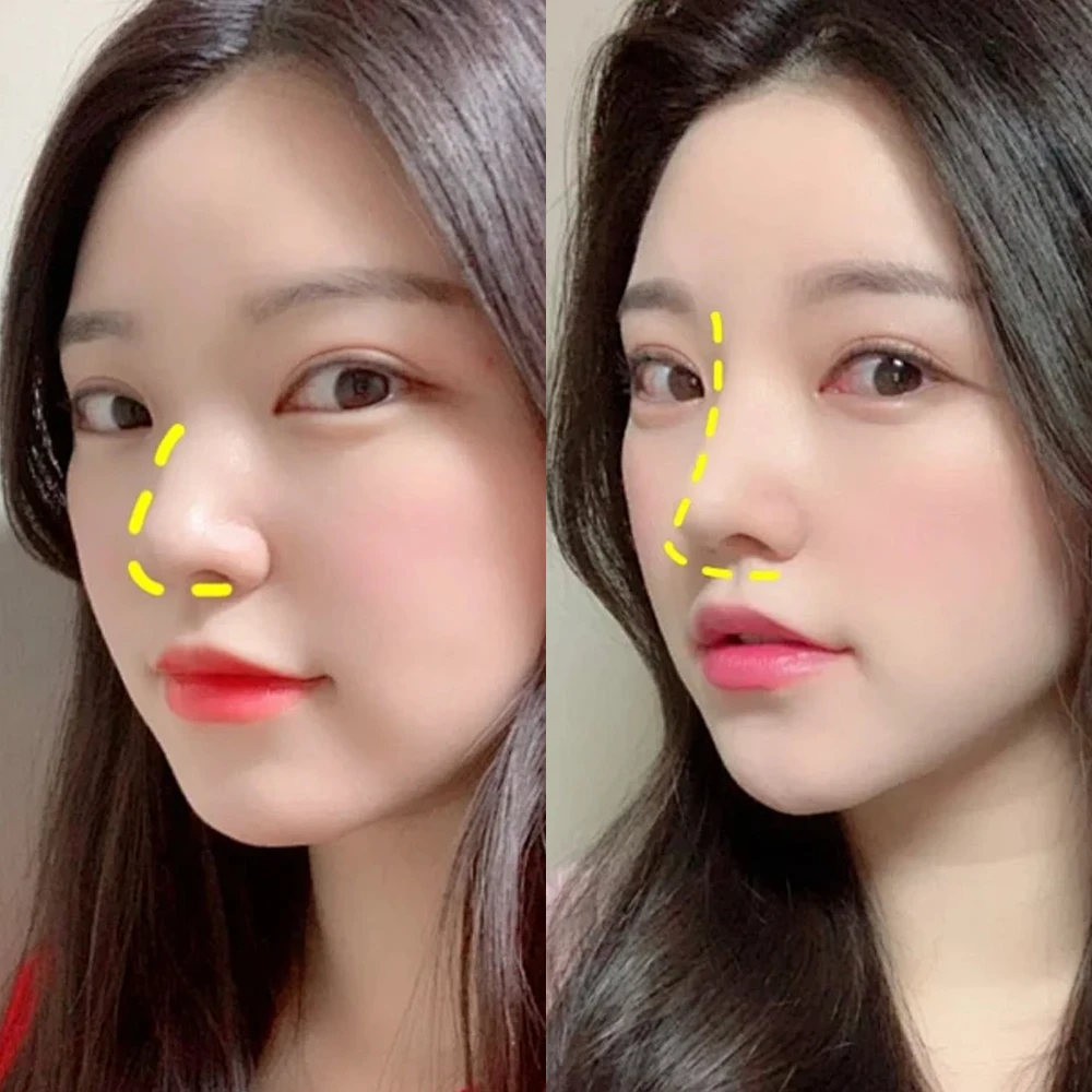 1-10PCS Reusable Thermoplastic Nose Clip Breathable Nose Bridge Height Corrector Shrinking Nasal Wing Stickers Health Care Brace