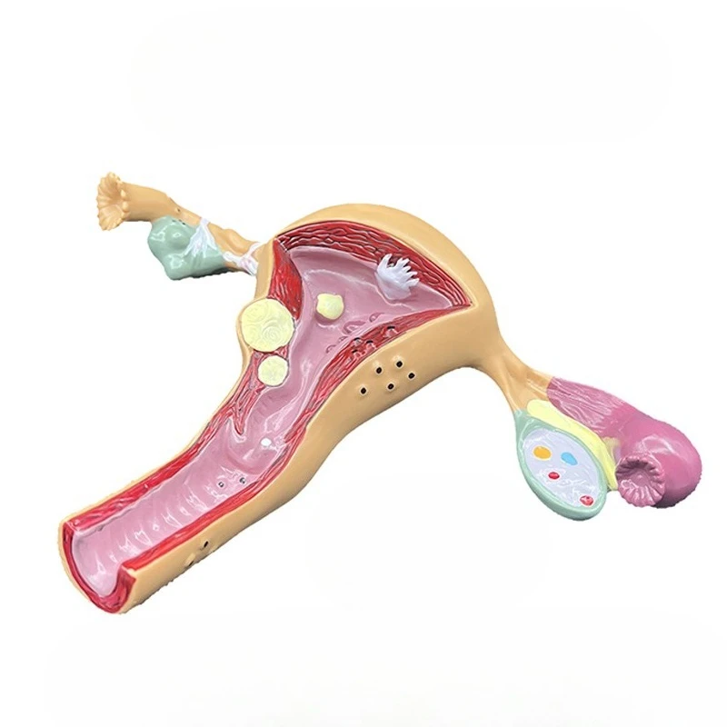 Uterine and ovarian model disease medical demonstration anatomical model
