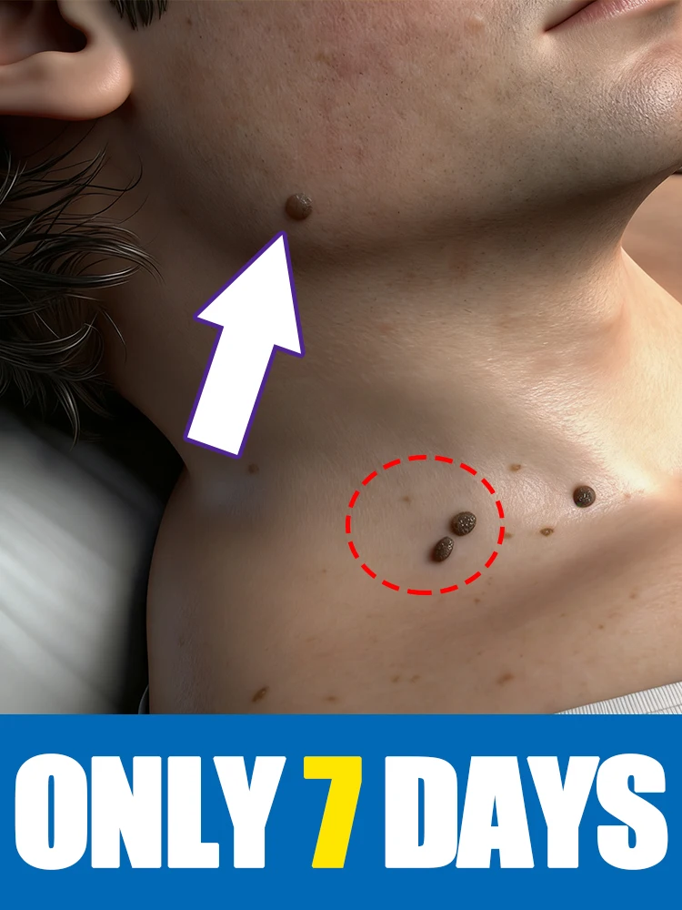 بيع مثل الكعك الساخن Generation-2، حول الثآليل، أدوات الجسم، حل مشكلك، للجنسين #1