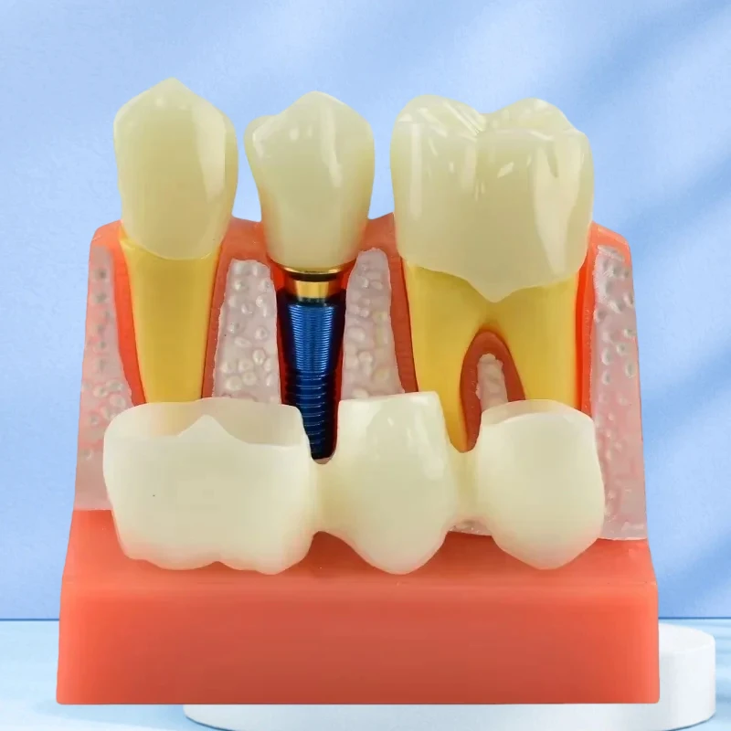 

4-кратный имплантат, обучающая модель зубов, демонстрация анализа имплантатов, съемная модель, обучающие инструменты для стоматолога