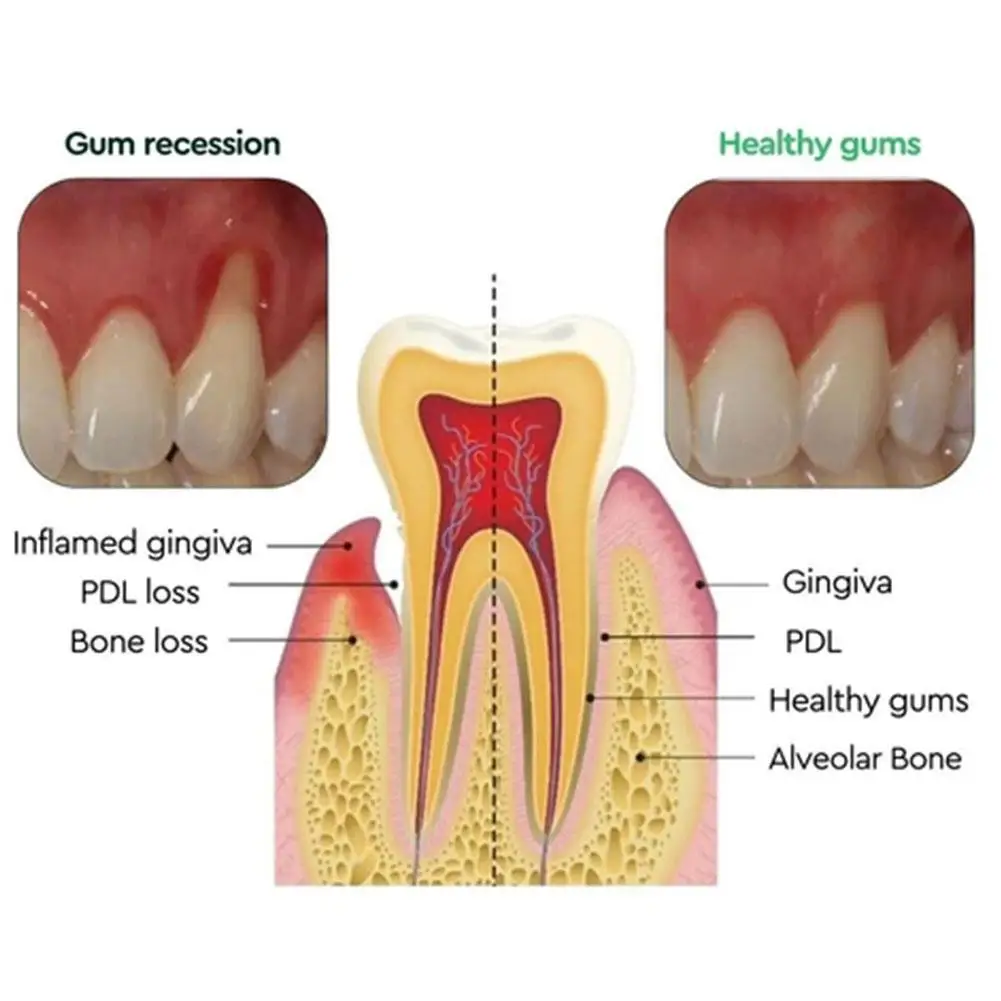 Tetesan pertumbuhan kembali gingiva dengan cepat memperbaiki rongga Caries pengobatan gusi Mousse untuk memulihkan gusi Anda dengan mudah