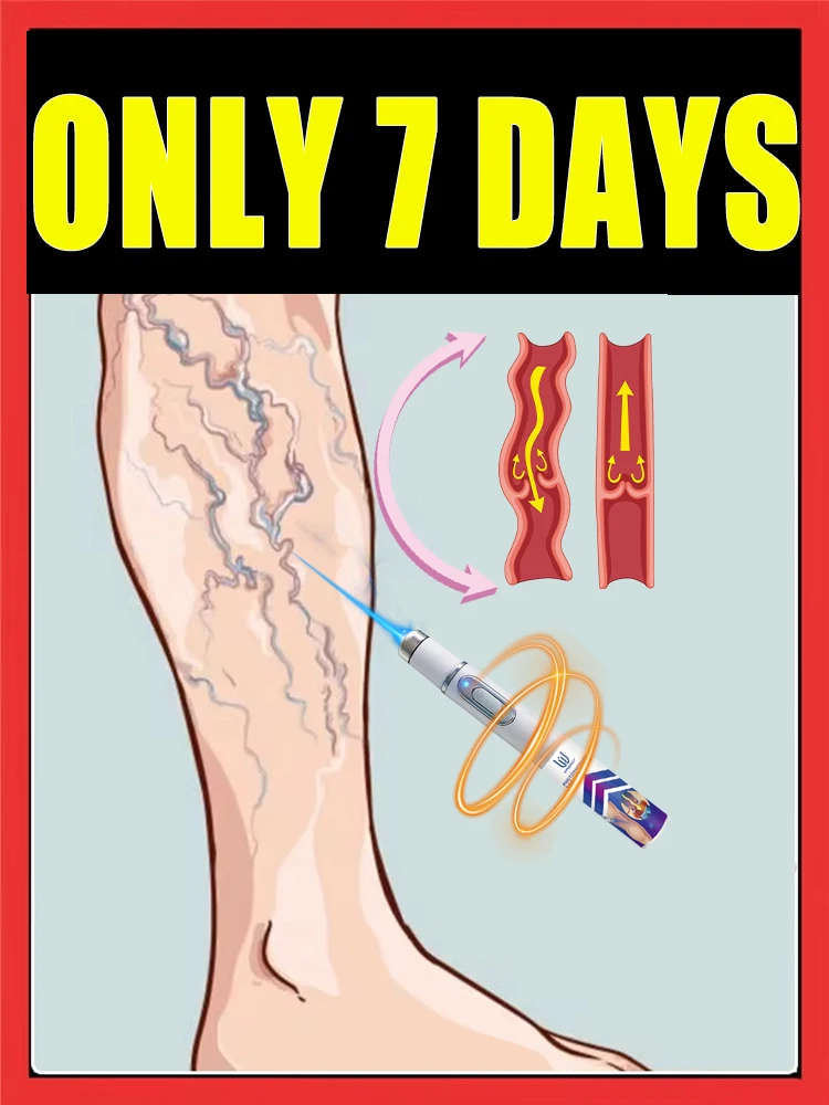 

Don't worry about varicose veins anymore! 7-day pain and swelling relief with gentle ingredients, super safe, portable leg prote