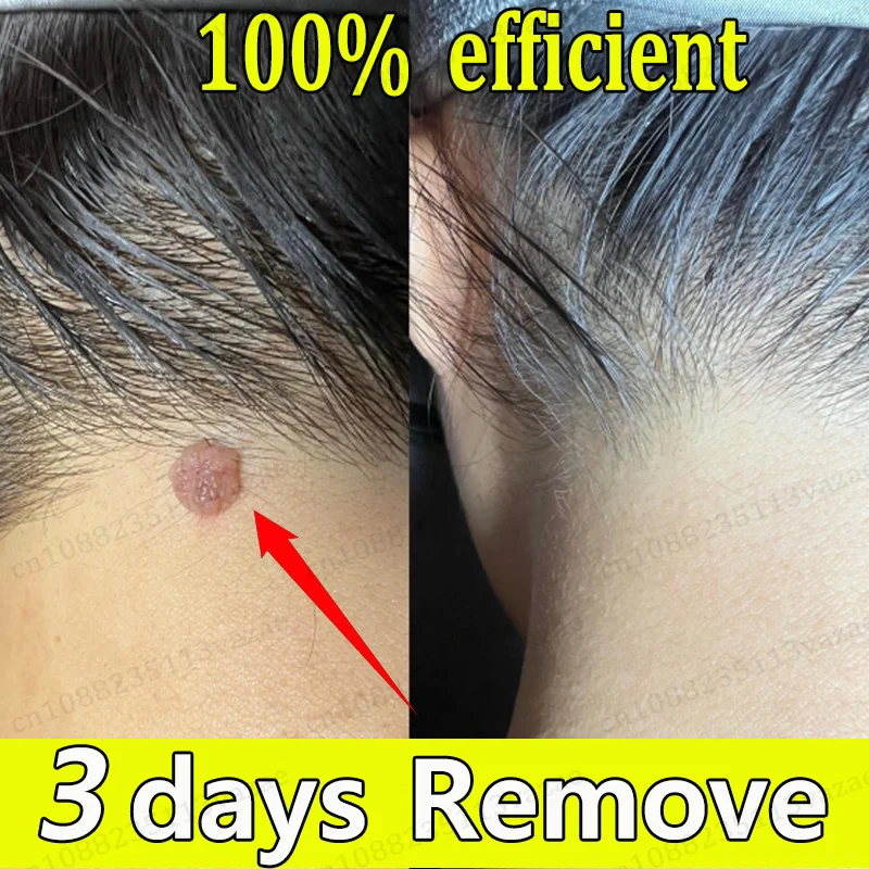 

Condyloma nkeinatum zal niet langer Gegen jou Bijou