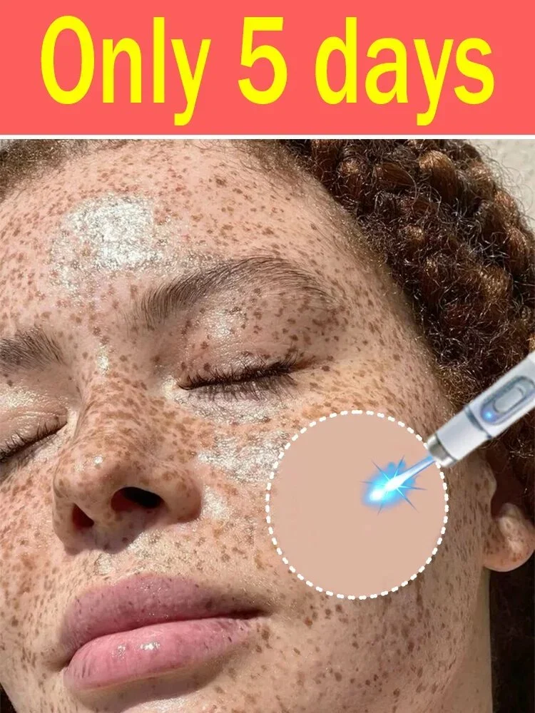 

Лучший продавец: лазерный точечный карандаш – удаление темных пятен и веснушек, ограниченное предложение