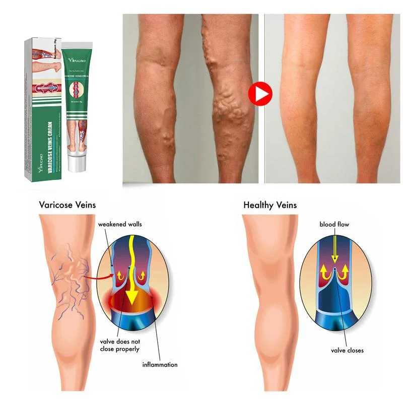 Creme eficaz do tratamento da veia varicosa, aliviar as pernas, vasculite dilatada, flebite, pomada fórmula natural