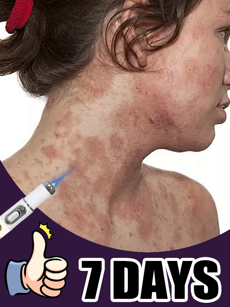 

2nd generation Vitiligo treatment pen, used to treat Vitiligo