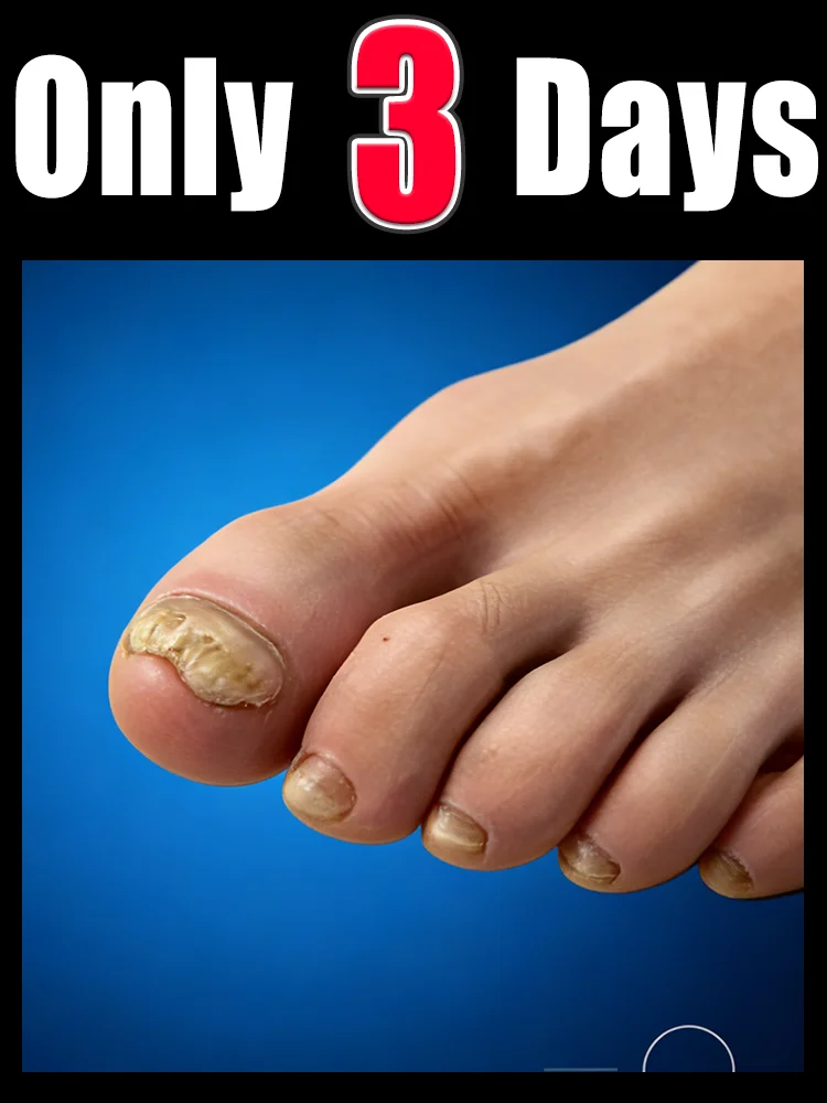 

Qᴜɪᴄᴋʟʏ ᴇʟɪᴍɪɴᴀᴛᴇ ғᴜɴɢᴜs ᴀɴᴅ ʀᴇsᴛᴏʀᴇ ʜᴇᴀʟᴛʜʏ ɴᴀɪʟs