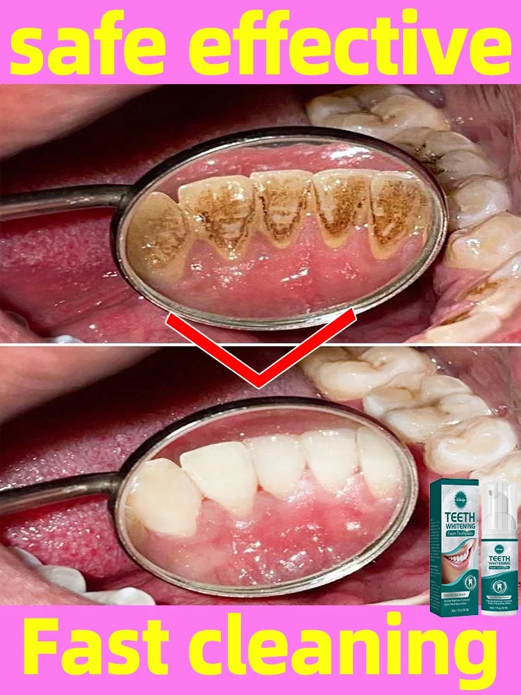 Tartar removers dissolve tartar and remove stains